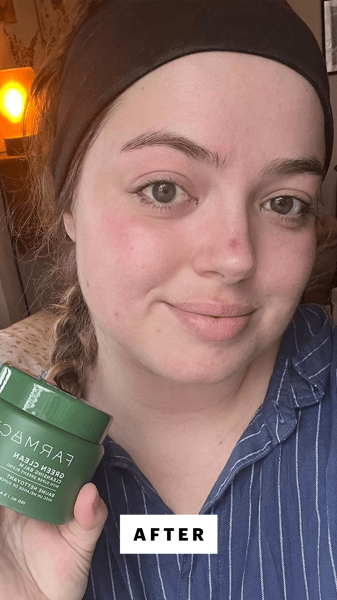 Hoffmann after applying the Farmacy Green Clean Cleansing Balm